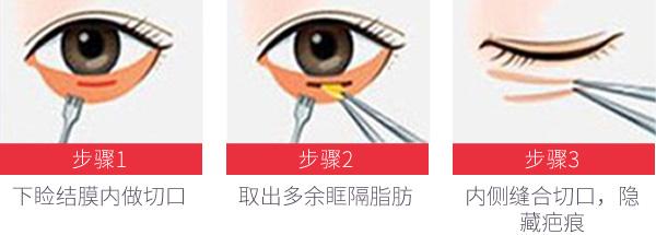 楊怡整容前后鼻子有變化嗎？