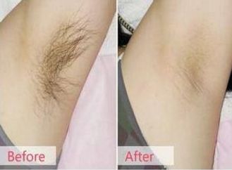 菏澤哪家醫(yī)院做雙眼皮效果好？