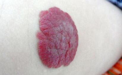 微創(chuàng)去眼袋是否安全有效？花費(fèi)和注意事項(xiàng)有何分析？某點(diǎn)推-微創(chuàng)去眼袋的價(jià)格探究？