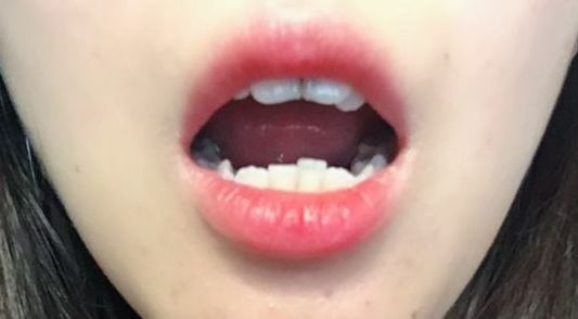 真相揭曉！angelbaby終于承認(rèn)整容了，來看看她的改變之路