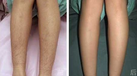 濰坊割雙眼皮前需要了解的6個最佳醫(yī)院，濰坊割雙眼皮醫(yī)院哪家好？