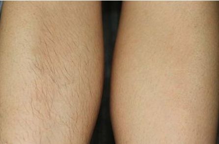 上海哪家醫(yī)院激光去痣好？解析上海頂級(jí)激光去痣醫(yī)院及技術(shù)