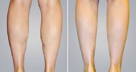 北京哪家整形醫(yī)院的玻尿酸注射效果好且價格合理？2023年北京愛貝芙注射玻尿酸排行前十醫(yī)院揭曉！