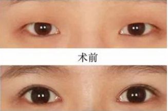 東莞哪家大腿抽脂醫(yī)院好？2023年排名前五強(qiáng)