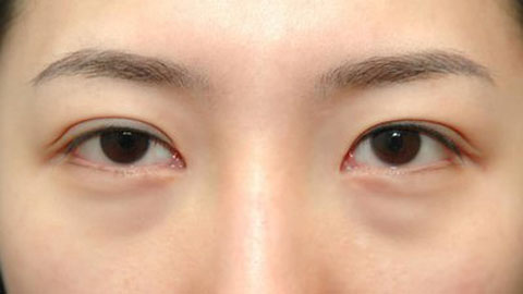 可行的符合要求的標(biāo)題為：想要不開刀隆鼻有哪些選擇？無需注射或植入硅膠假體的方法有哪些？