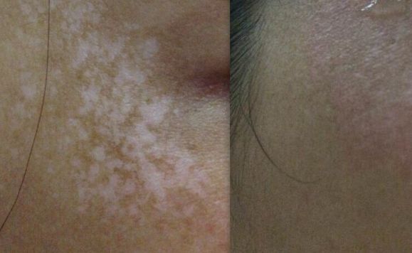 蘇州青春痘治療首選哪家醫(yī)院？找個專業(yè)靠譜的醫(yī)院解決青春痘問題