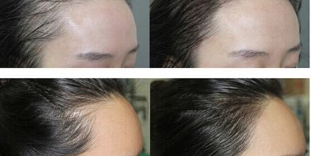 東莞做光子嫩膚哪家醫(yī)院專業(yè)靠譜？