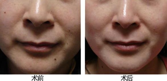 廣州做咬肌好的美容醫(yī)院有哪些？選擇哪家醫(yī)院效果最好？