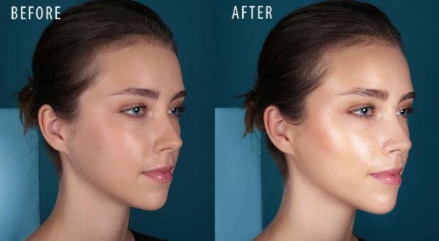 激光治療痤瘡費(fèi)用高嗎？什么因素決定了治療價(jià)格？