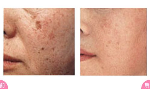 哈爾濱鼻整形醫(yī)院哪家好？選擇適合您的哈爾濱鼻整形醫(yī)院