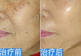 阜陽祛疤痕哪家醫(yī)院好？如何選擇適合自己的祛疤痕醫(yī)院？