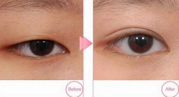 成都去雀斑哪家醫(yī)院好？挑選出適合你的四家頂級(jí)醫(yī)院！