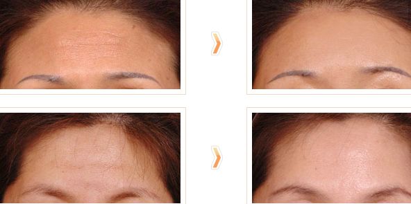 南寧醫(yī)院哪家專業(yè)治療黃褐斑效果好？