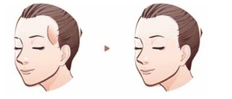 面對(duì)超5成大學(xué)生脫發(fā)現(xiàn)象，你知道如何自救嗎？