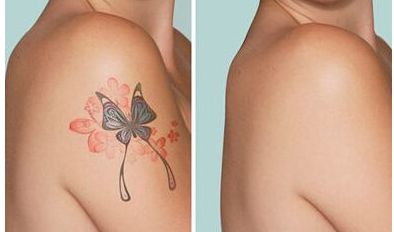 西安去胎記權(quán)威醫(yī)院排名及費(fèi)用如何？