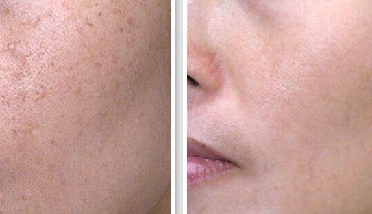 福州哪家祛斑醫(yī)院好？細(xì)數(shù)福州市區(qū)的頂級祛斑醫(yī)院