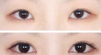 杭州哪家醫(yī)院做抽脂手術(shù)好，手術(shù)效果怎么樣，術(shù)前注意事項(xiàng)有哪些