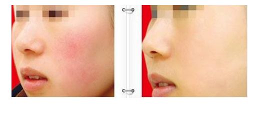 廣州哪家去掉疤痕醫(yī)院好？專家點(diǎn)評(píng)與患者評(píng)價(jià)揭示真相