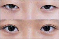 深圳哪些整形醫(yī)院是正規(guī)的韓式開眼角?？疲?023年評分排名前十強的尤其知名！