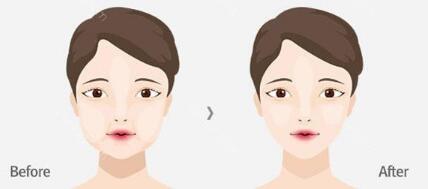 哪些地方可以進(jìn)行面部豐脂手術(shù)？術(shù)后要注意哪些事項(xiàng)？