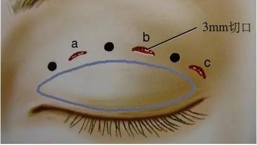 袁泉整容了嗎？曝光她疑似整容前后對比照片，網(wǎng)友熱議美容手術(shù)真相。