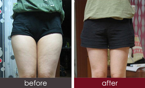 鄭州E光除抬頭紋口碑好排名靠前的整形醫(yī)院