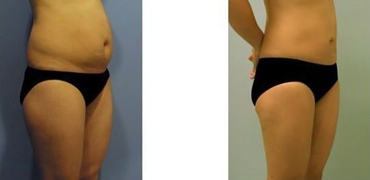 全國哪家醫(yī)院的脂肪填充效果最好？