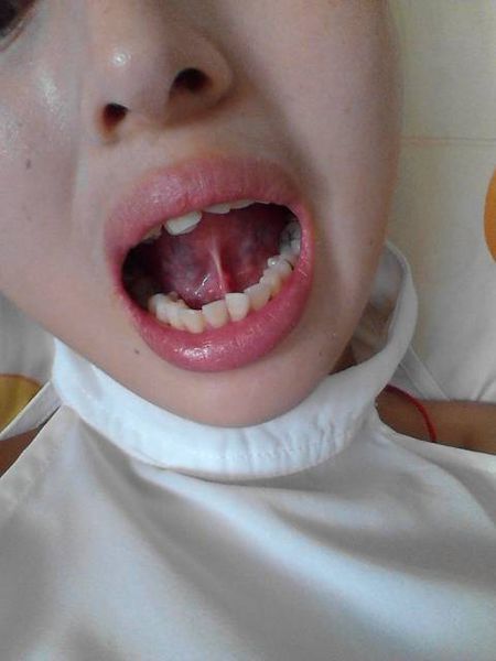 清遠哪家整形醫(yī)院專業(yè)祛生長紋效果好？2023年非常受歡迎的激光點陣整容機構(gòu)推薦！