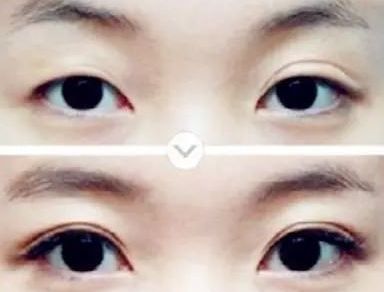 上海瘦小腿哪家醫(yī)院效果好，如何選擇最適合自己的瘦腿醫(yī)院？