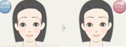 熱瑪吉具體有哪些價(jià)格及術(shù)后注意事項(xiàng)？