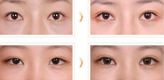 達(dá)州去眼袋的醫(yī)院哪家專業(yè)靠譜？