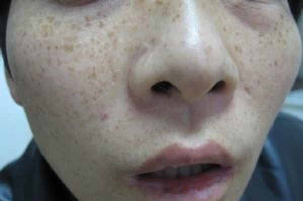 小腿激光脫毛需付出多少金錢？脫毛后需注意哪些保養(yǎng)事項(xiàng)？