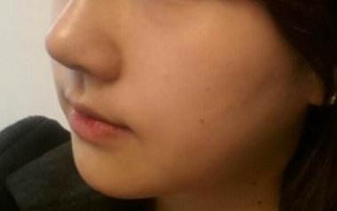 如何通過(guò)注射來(lái)實(shí)現(xiàn)減脂瘦身的目標(biāo)？揭秘減脂原理是什么？