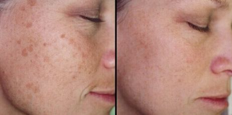 湖南去疤痕哪家醫(yī)院好？專家推薦的湖南治療疤痕首選！