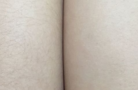 杭州治療痘坑的醫(yī)院哪家好？選擇靠譜專業(yè)的醫(yī)院，告別痘坑煩惱