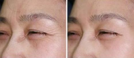 長(zhǎng)春祛痘印痘疤哪家醫(yī)院好？探尋長(zhǎng)春市最受用戶歡迎的祛痘佳所！