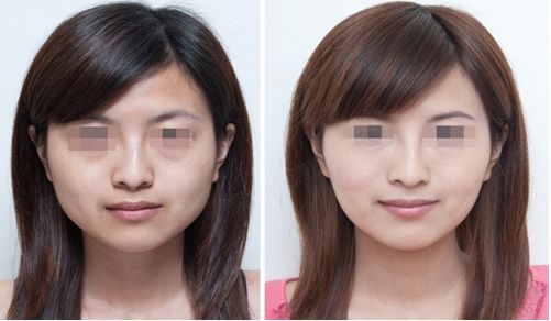 烏魯木齊哪家醫(yī)院隆鼻效果好？