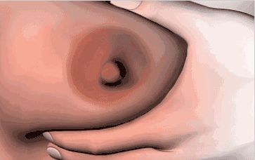 如何用玻尿酸改善面部法令紋？快速消除法令紋的方法有哪些？