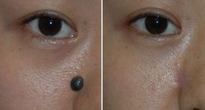 任丘激光去疤痕哪家醫(yī)院好？權(quán)威評測帶你尋找最適合的醫(yī)院！