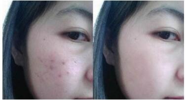 為什么光子嫩膚后要注意哪些事項(xiàng)？點(diǎn)進(jìn)來了解一下吧！