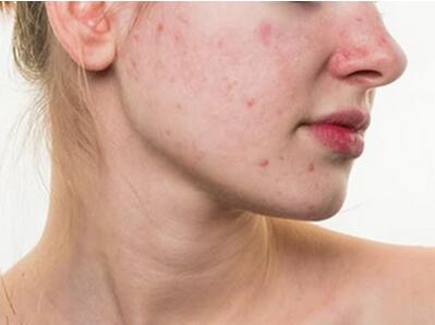 注射玻尿酸除皺是否安全？一探醫(yī)美“萬金油”的副作用