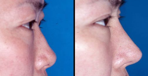 遼陽市割雙眼皮哪家好？價格、技術(shù)、口碑全面解析！