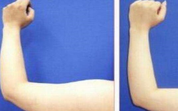 上瞼提肌手術(shù)的收費是否昂貴？