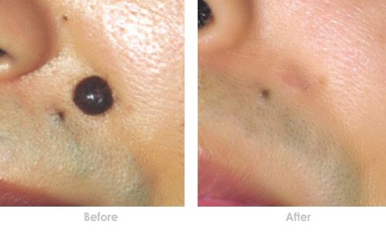 深圳隆鼻哪家醫(yī)院好？選擇正規(guī)專業(yè)的隆鼻醫(yī)院，確保您的美麗無憂