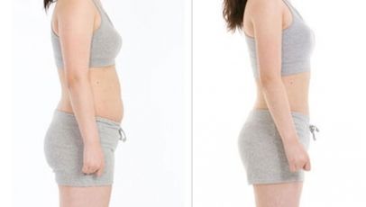 蘇州埋線雙眼皮效果如何？哪家醫(yī)療機(jī)構(gòu)值得選擇？