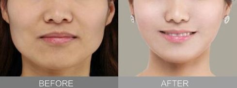 湖州下巴整容醫(yī)院哪家好？推薦湖州地區(qū)專業(yè)下巴整容醫(yī)院排行榜