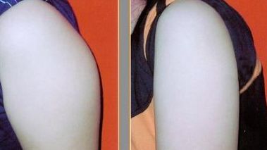 長(zhǎng)沙美容專家分析各種吸脂技術(shù)，用戶口碑持續(xù)贊譽(yù)