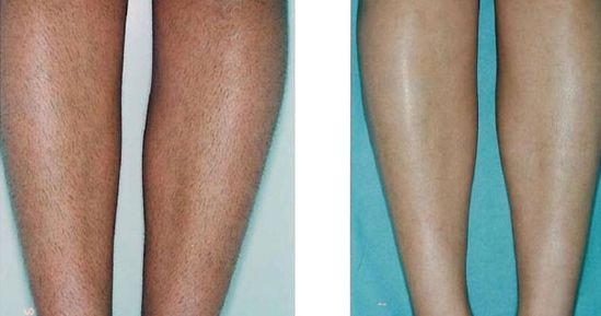 成都有哪些專業(yè)治療胎記的醫(yī)院？哪家醫(yī)院的治療效果好呢？