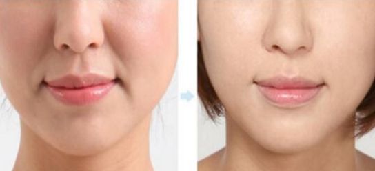 上海下頜角術(shù)醫(yī)院哪家專業(yè)可靠？