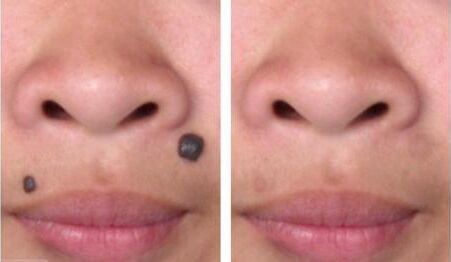 胎記是否可通過激光手術(shù)去除？激光去胎記的優(yōu)點(diǎn)有哪些？